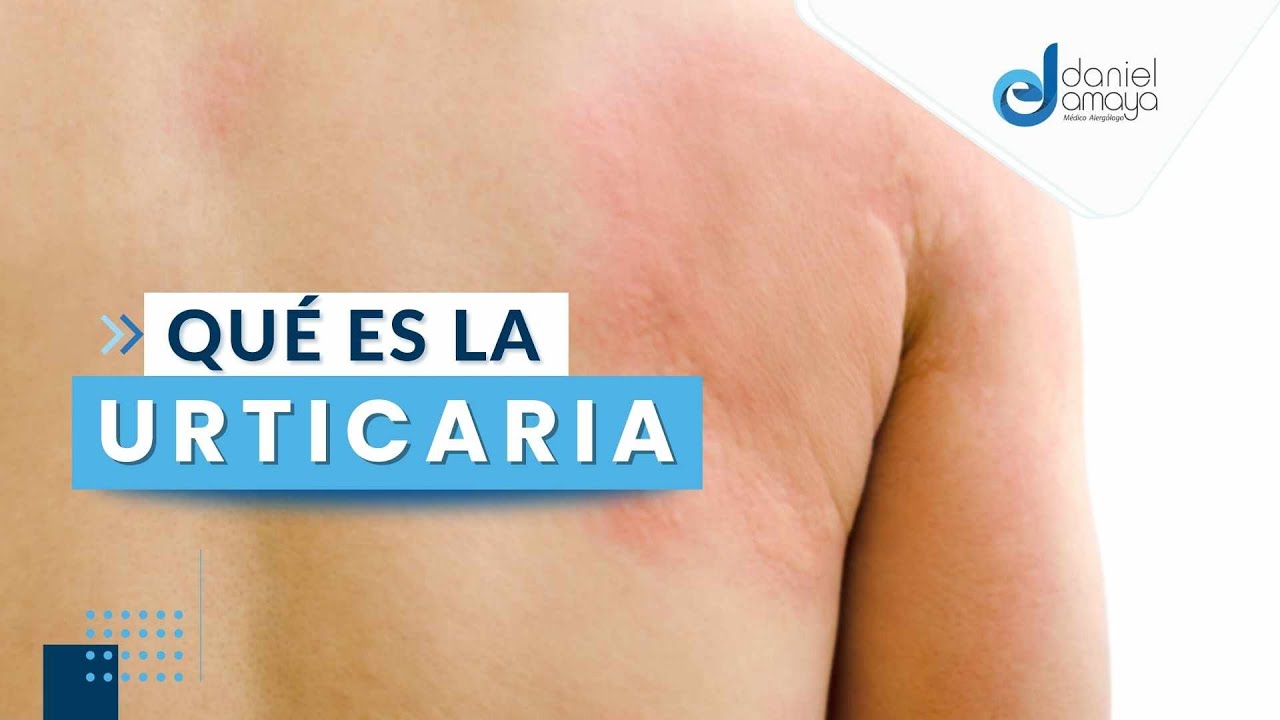 alergia en la piel por estres