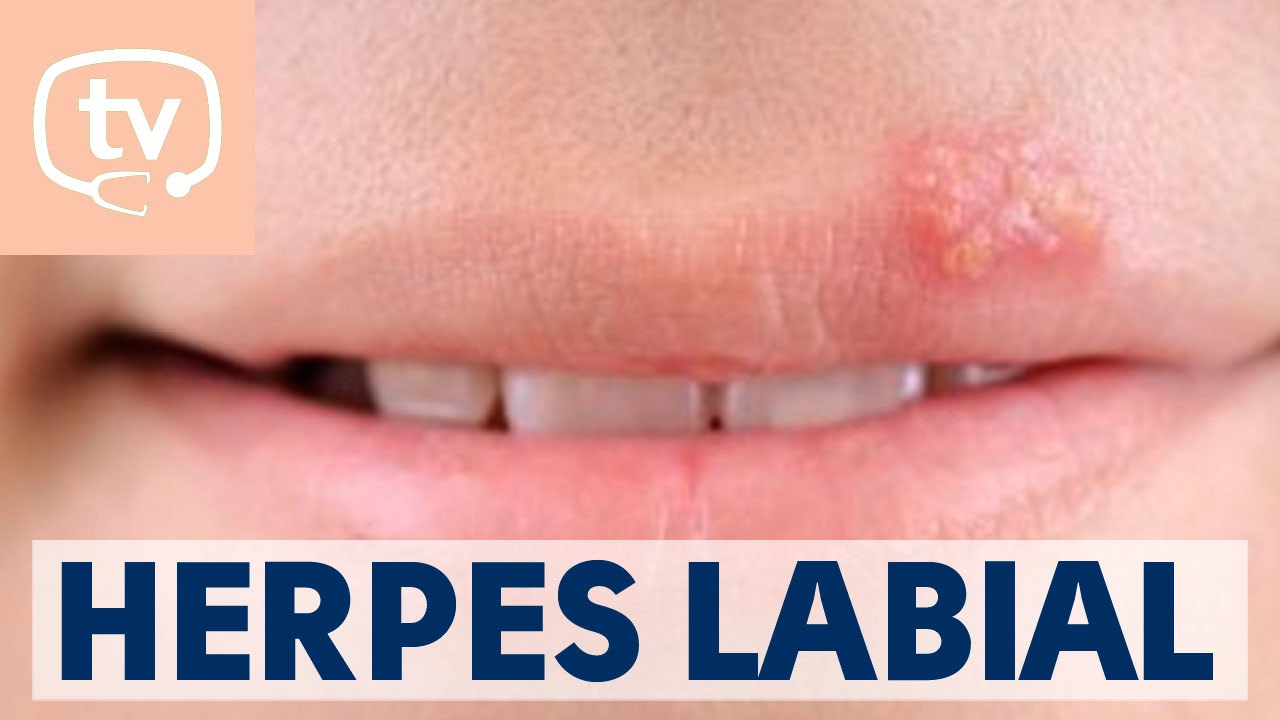como quitar herpes labial en una noche