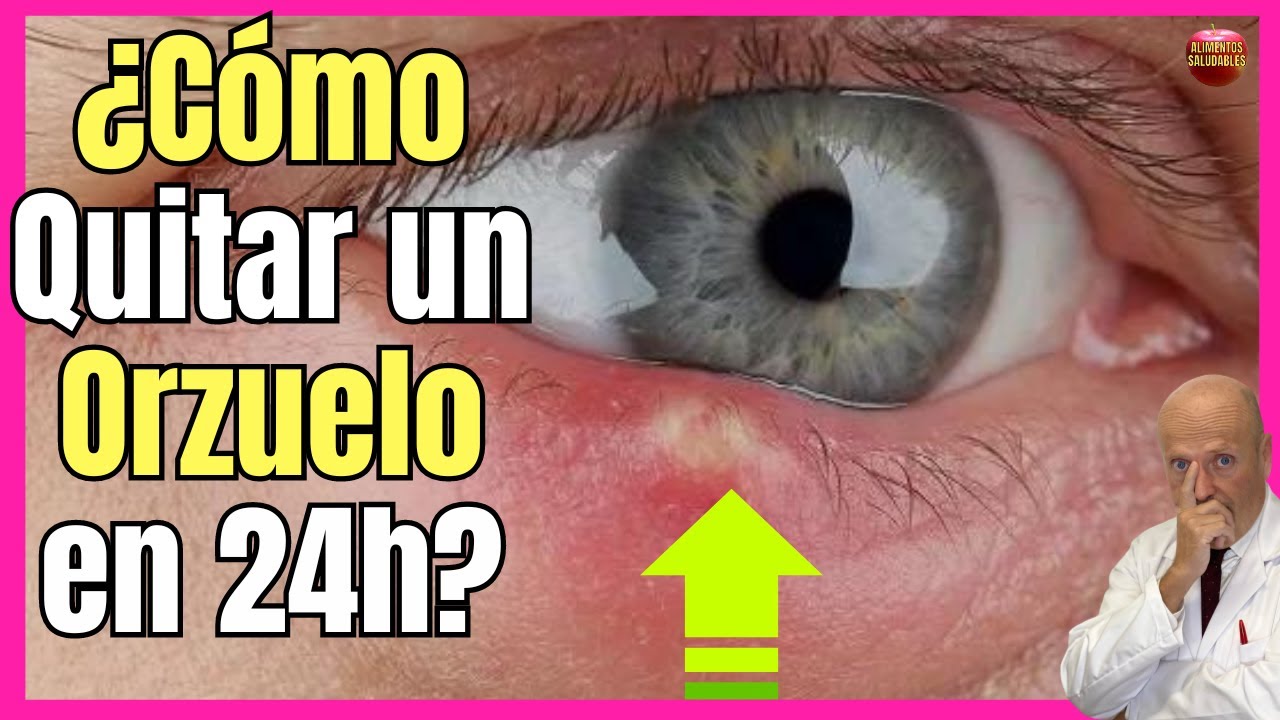 como quitar un orzuelo en 24 horas