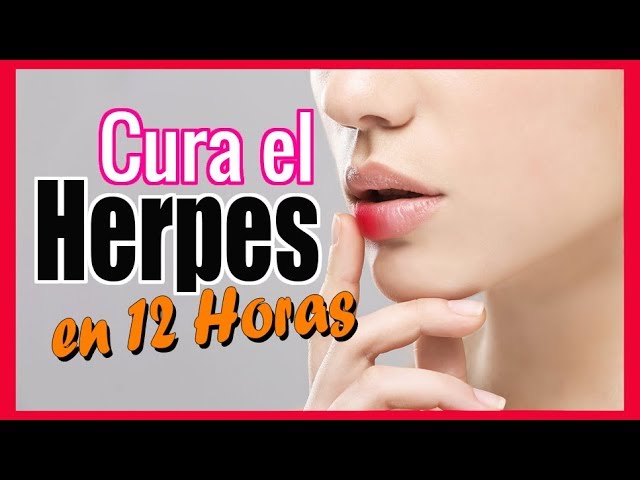 eliminar herpes labial en horas remedios caseros