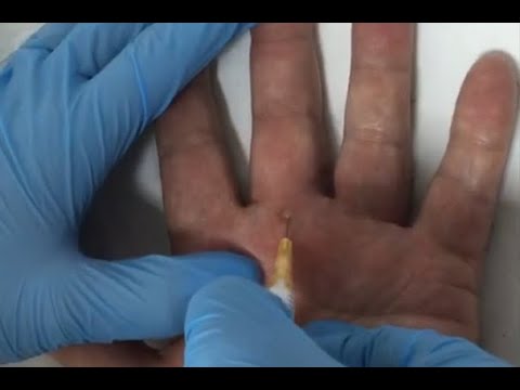 inflamados tendones de los dedos de la mano