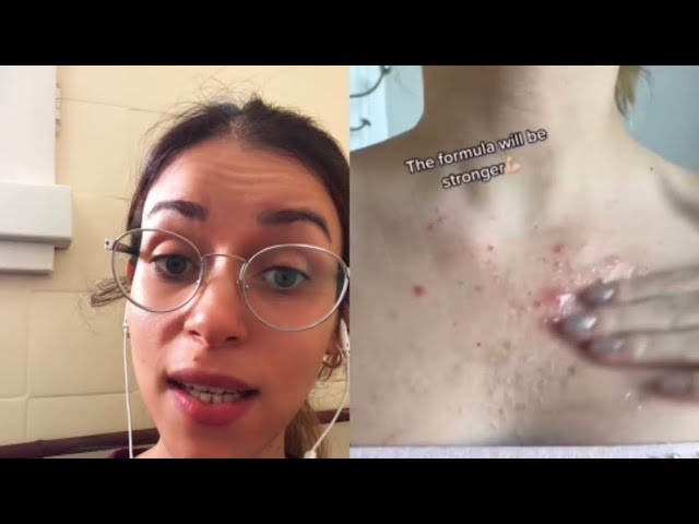 tipos de granos en el pecho mujer