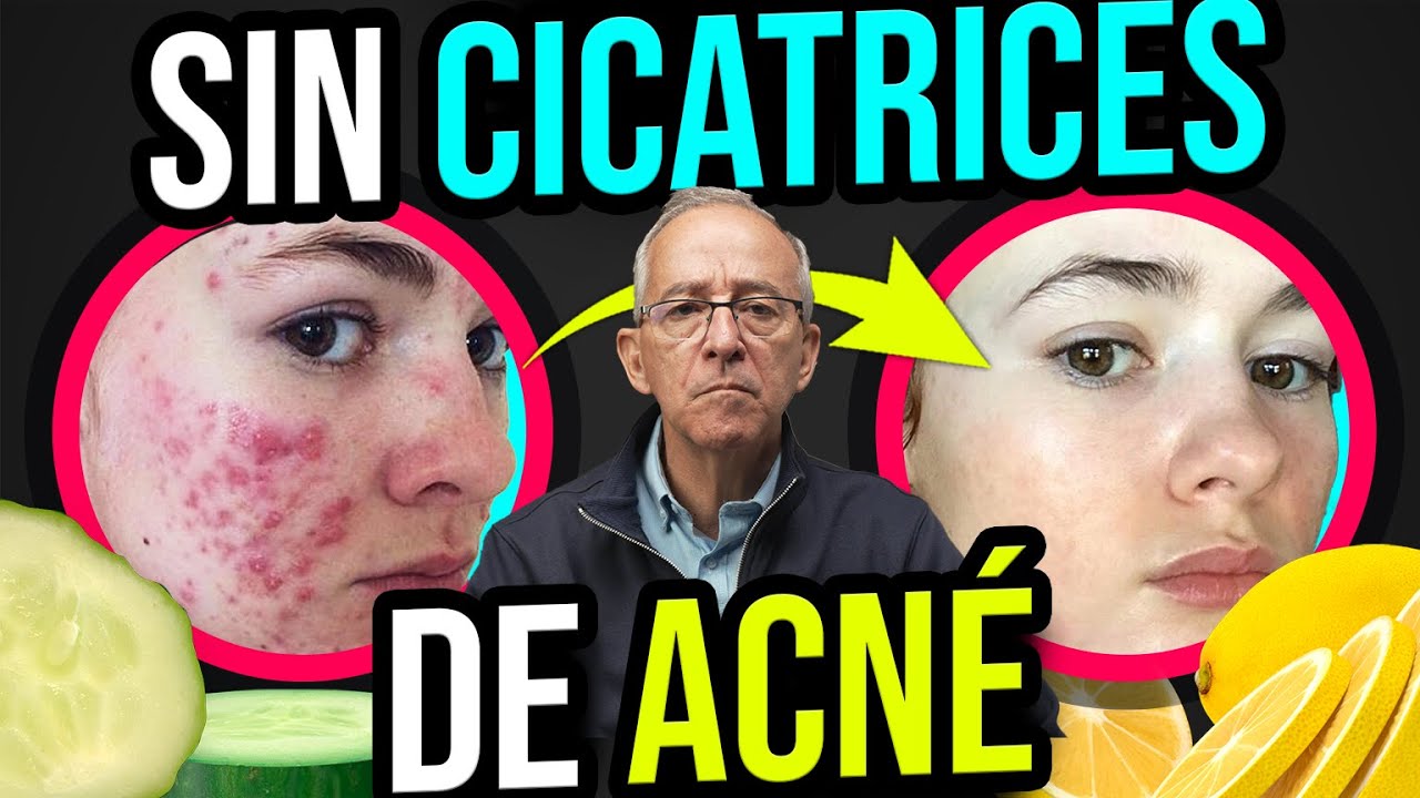 como eliminar marcas de acne naturalmente