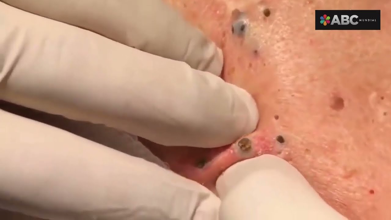 como sacar espinillas negras de la cara