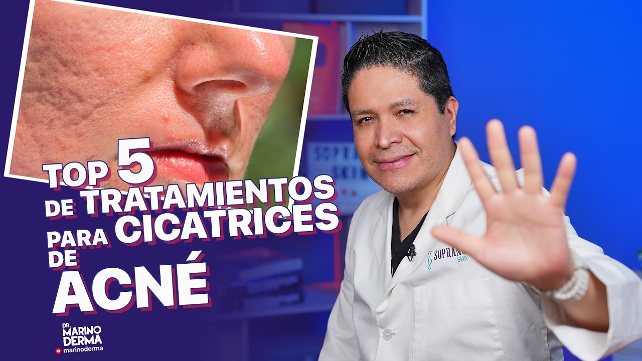 el mejor tratamiento para eliminar cicatrices de acné