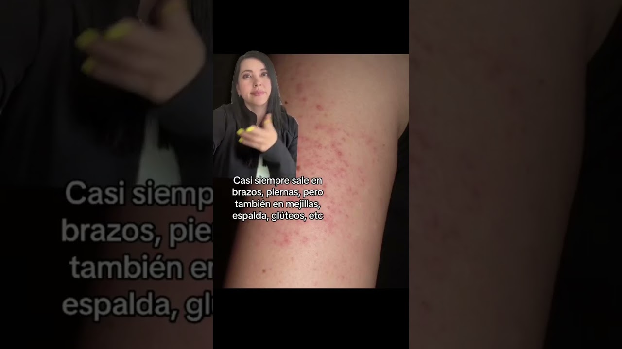 granos en los brazos por estrés