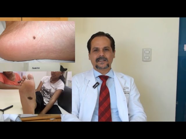 lunares en la planta del pie