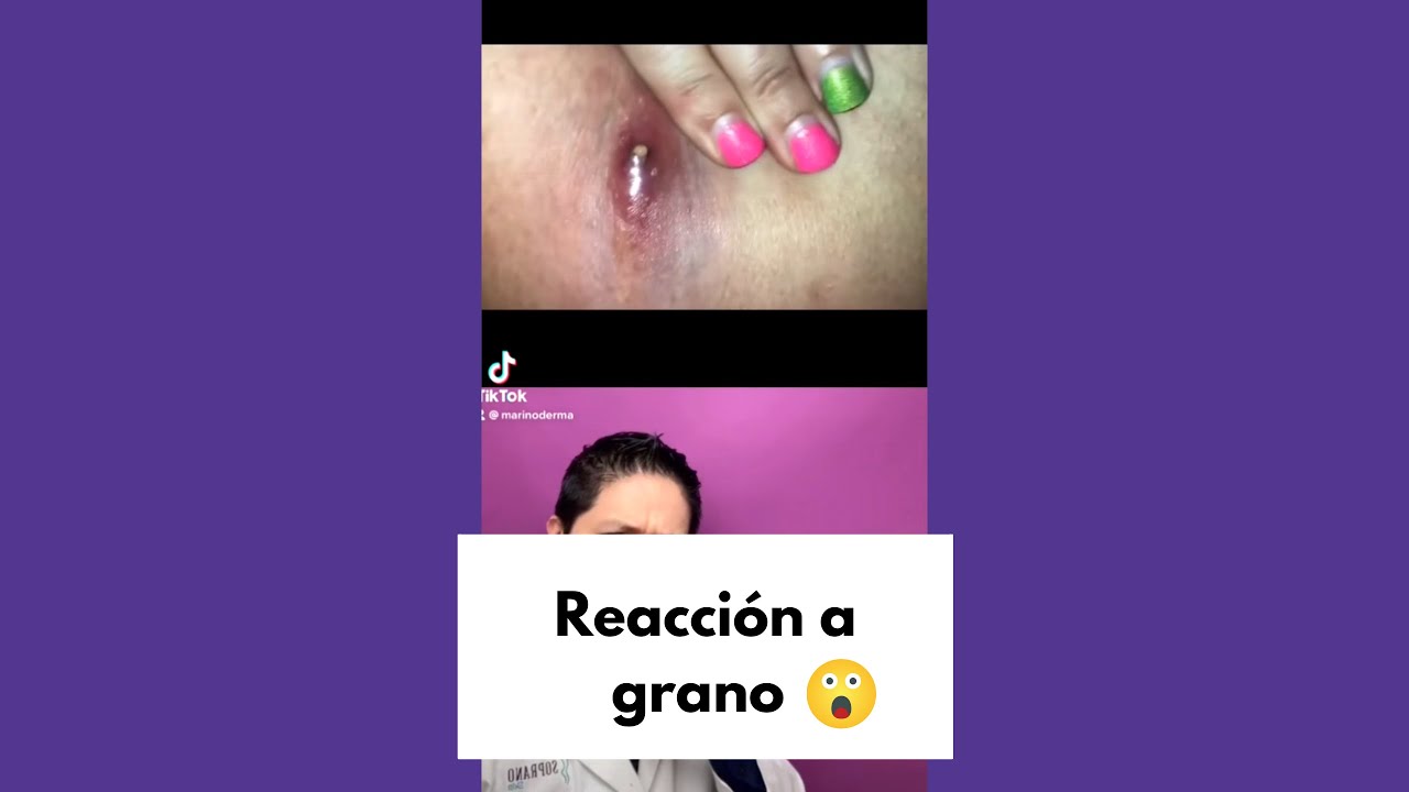 tipos de granos en la entrepierna