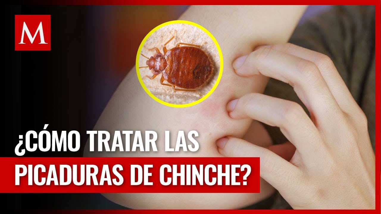 cómo son las picaduras de los chinches
