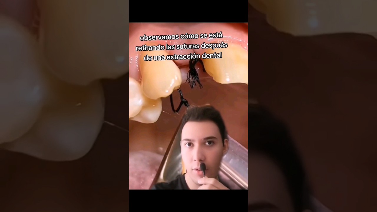 cuanto tardan en caer los puntos de la boca