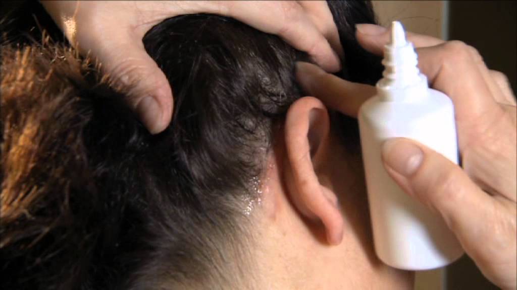 líquido para la psoriasis en el cuero cabelludo