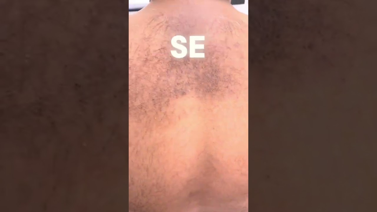 manchas en la espalda por estres