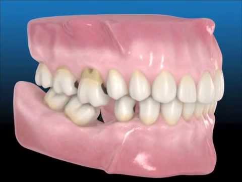relación entre caída de dientes y crecimiento