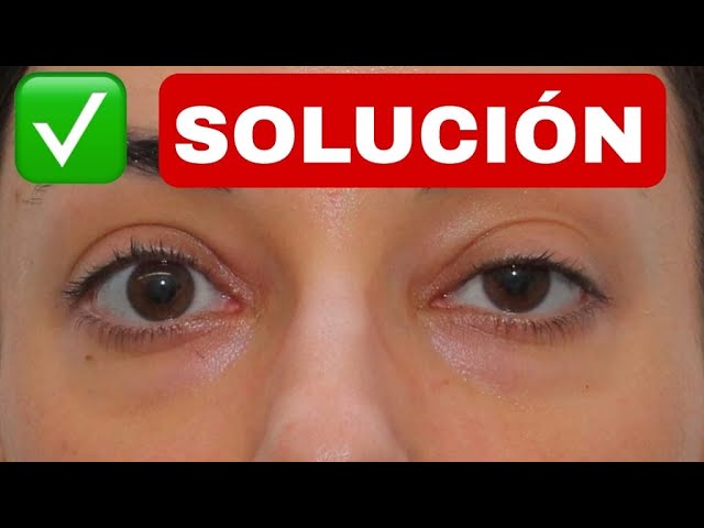 un ojo mas grande que el otro