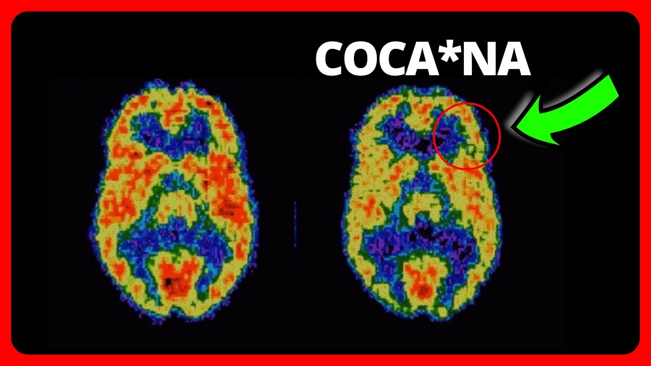 cuanto dura el síndrome de abstinencia de la coca