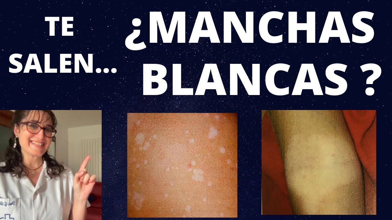 manchas blancas en la piel por el sol remedios caseros