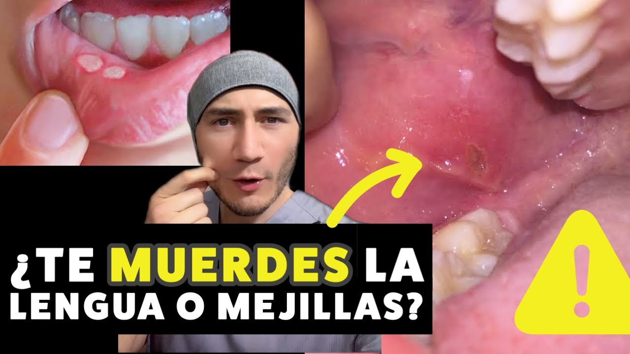 morderse la boca por dentro sin querer