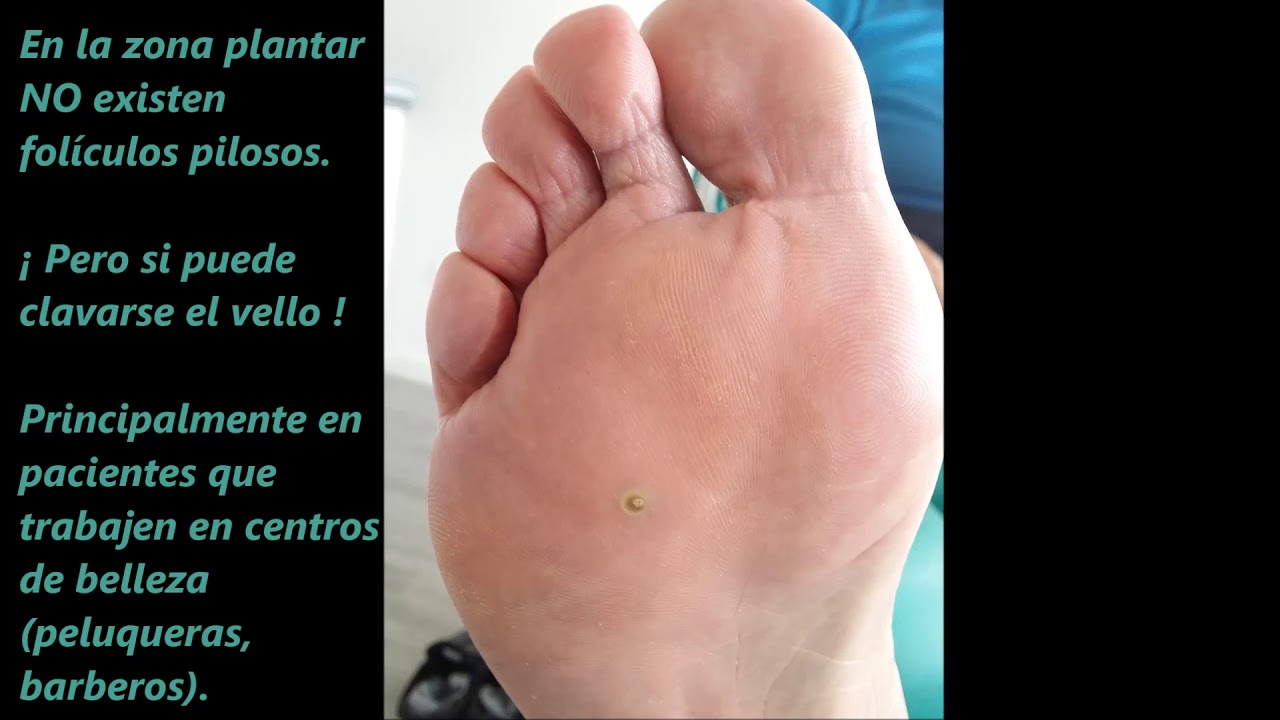 pelo en la planta del pie