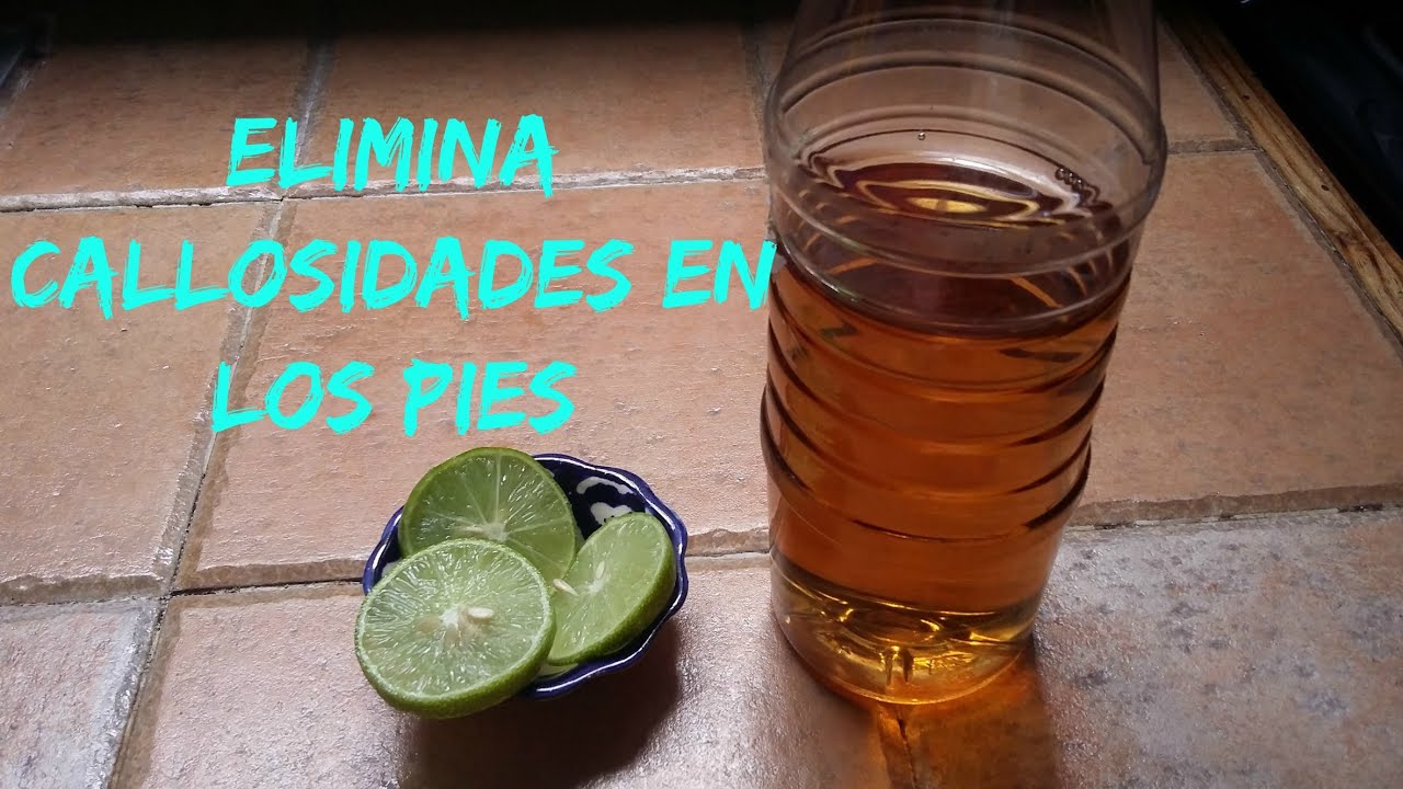 remedio caseros para los callos de los pies
