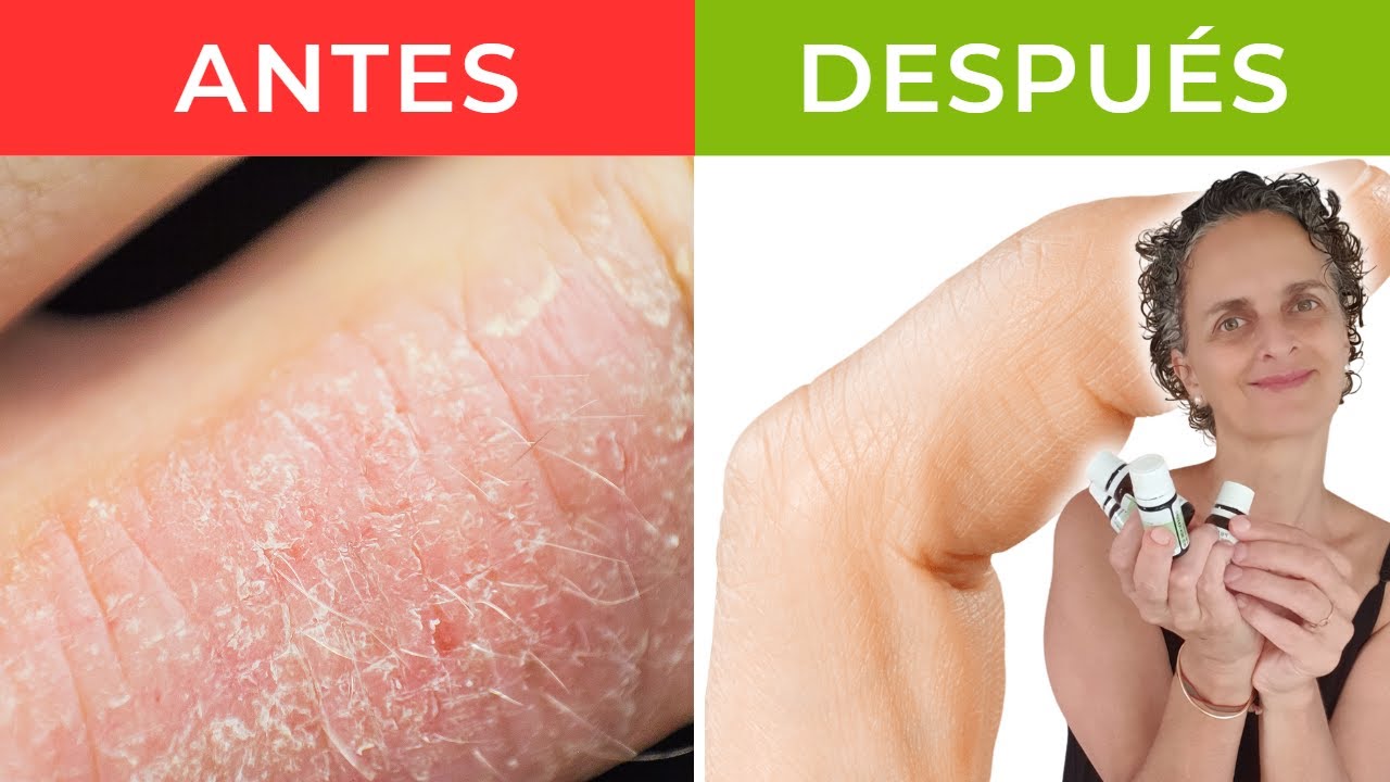 el mejor aceite esencial para la dermatitis