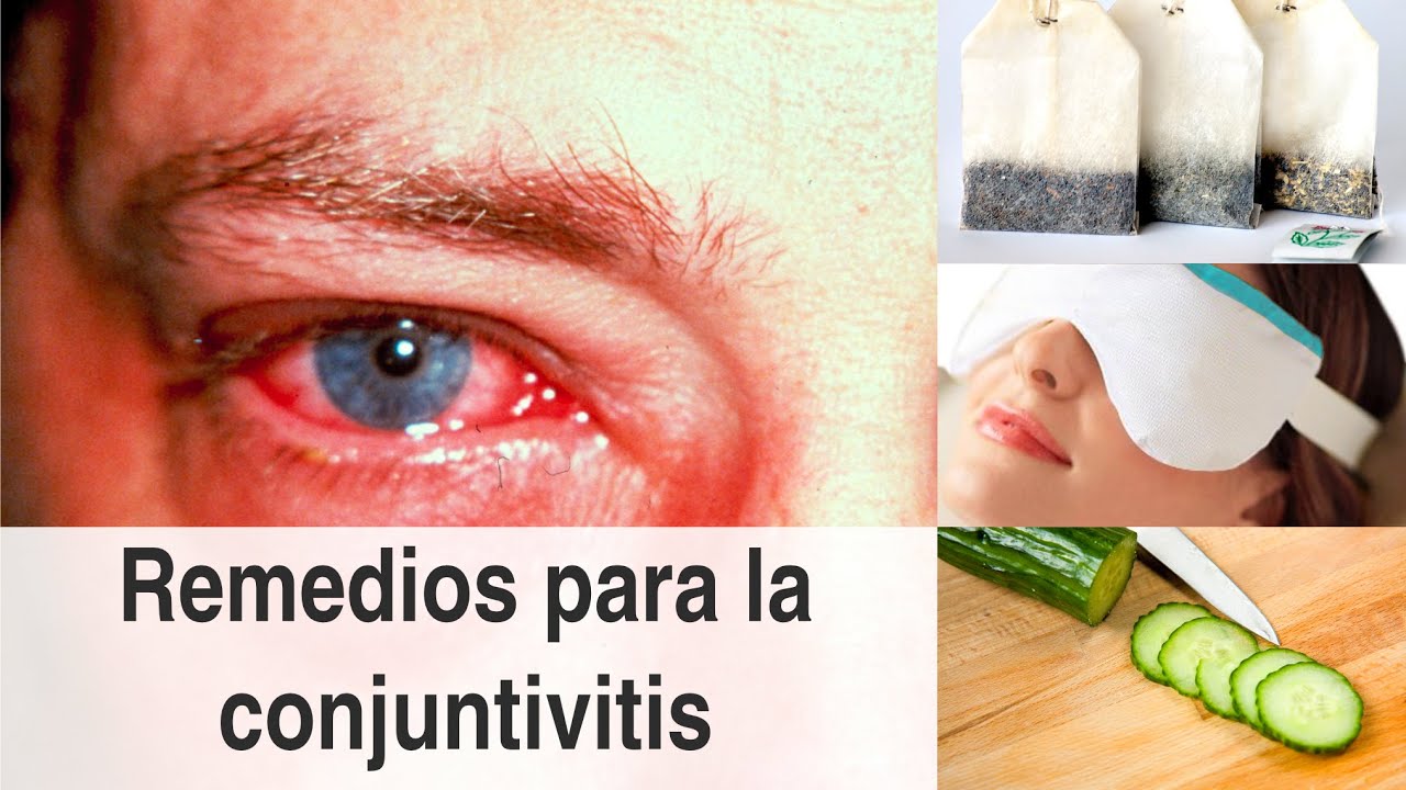 medicamentos para la conjuntivitis sin receta