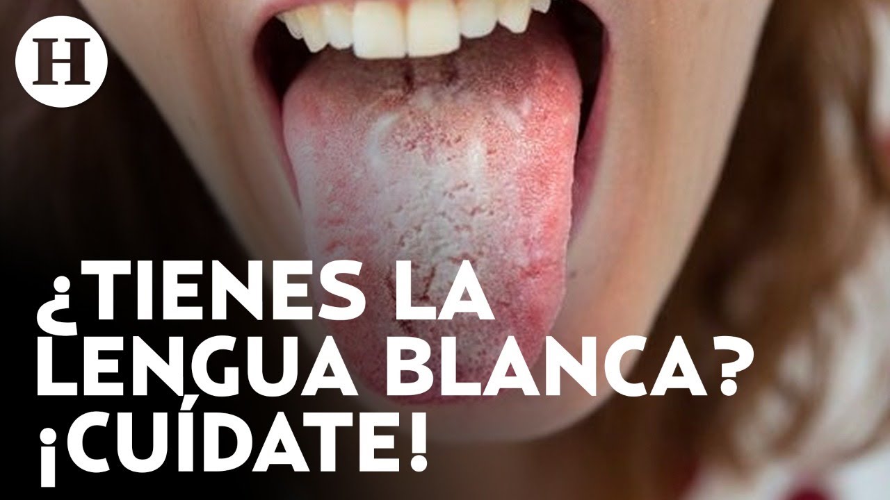 puntos blancos en la lengua y dolor