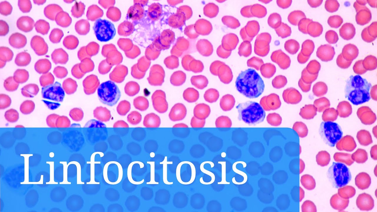 q pasa si tengo los linfocitos altos
